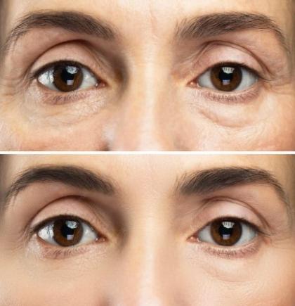 Leke ve Anti-Aging Bakımları